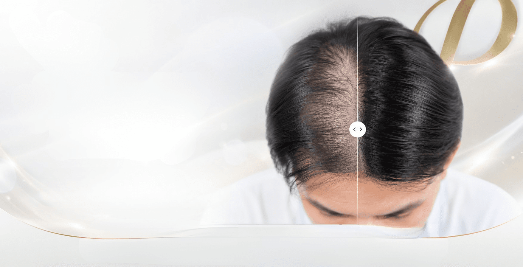 ฟื้นฟูเส้นผมด้วย Fractional Hair Laser