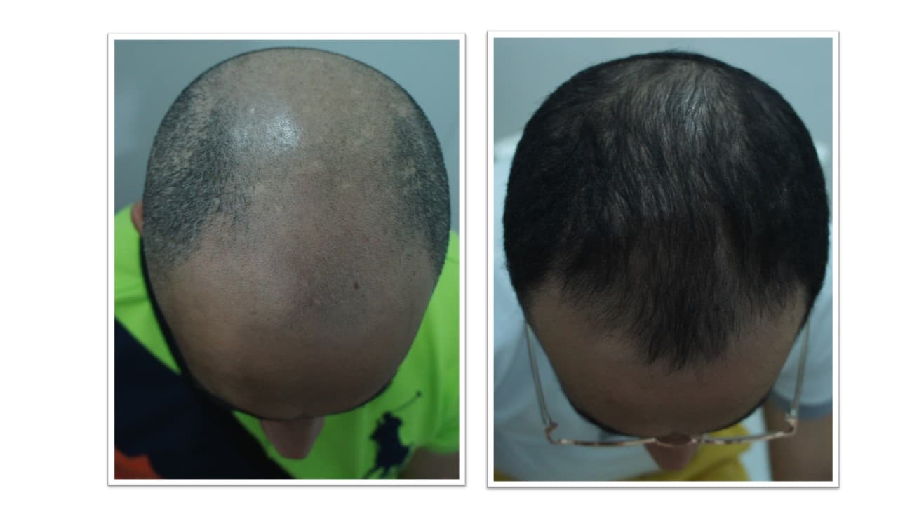 Hair Loss 薄毛の原因と治療法について