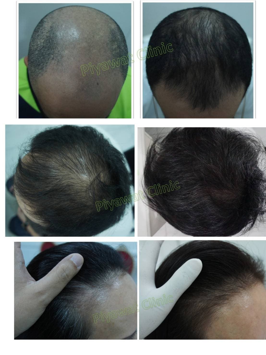 Common Question about Hair Loss and Hair Thinning