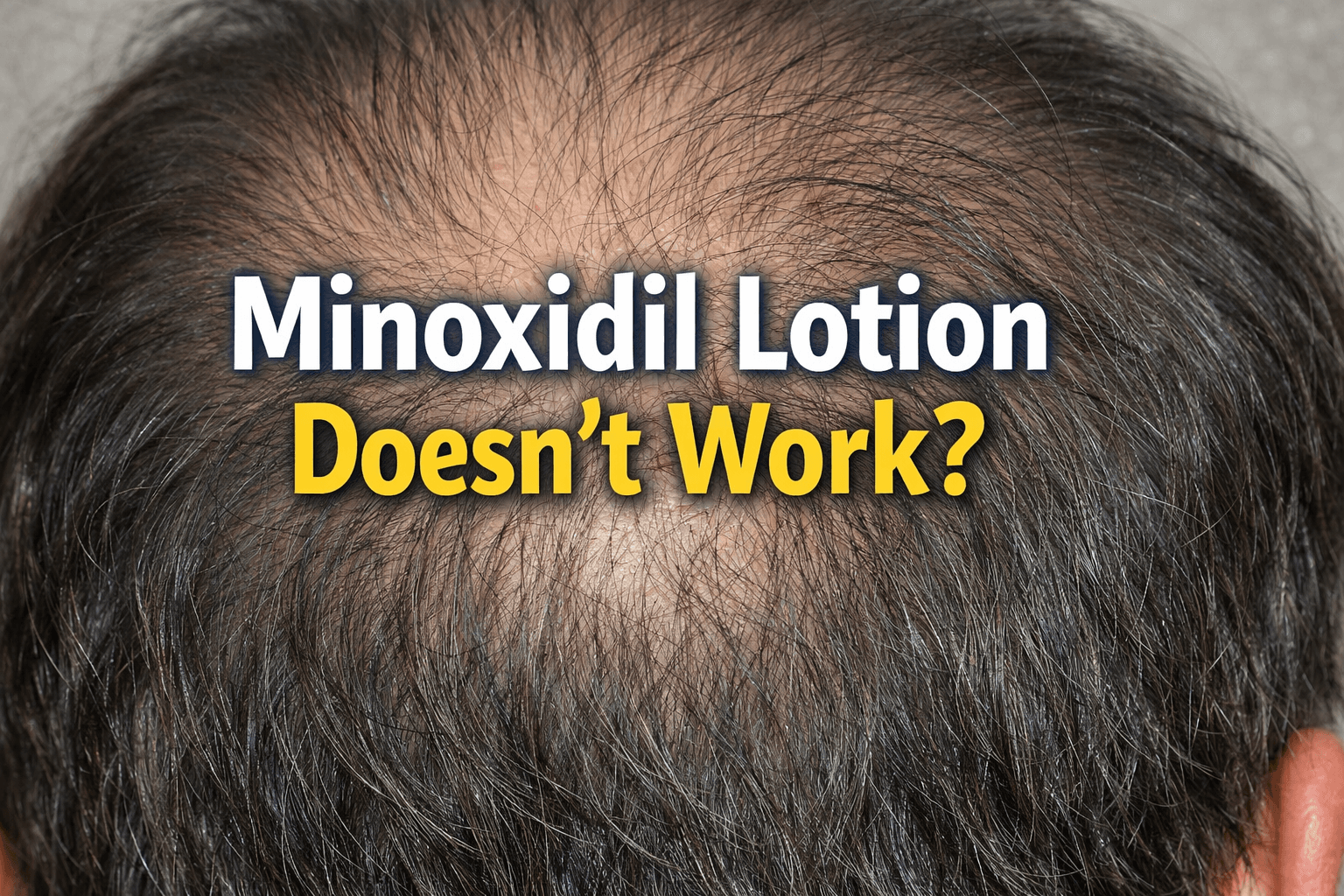 The Hidden Limits of Minoxidil Treatment (J)