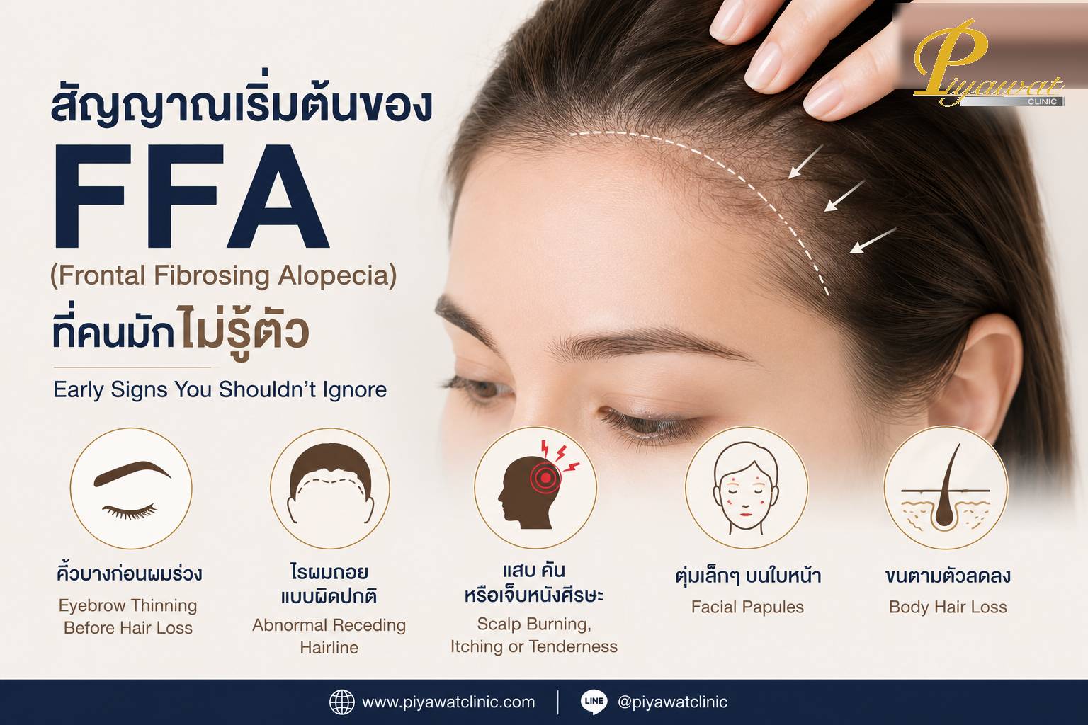 Frontal Fibrosing Alopecia (FFA):症状は、多くの場合、本人がそれに気づいていないことから始まります。脱毛前は眉毛が薄い?私の髪が変な方法で後退しますか?頭皮が焼ける?普通の薄毛ではないかもしれません。