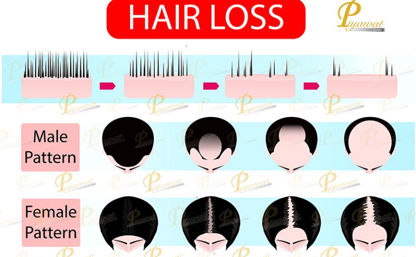 Male and Female Pattern Hair loss
