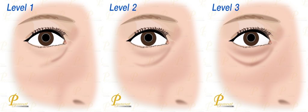 ร่องใต้ตา ร่องน้ำตา Tear Trough