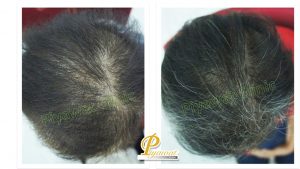 Hair Loss in women
