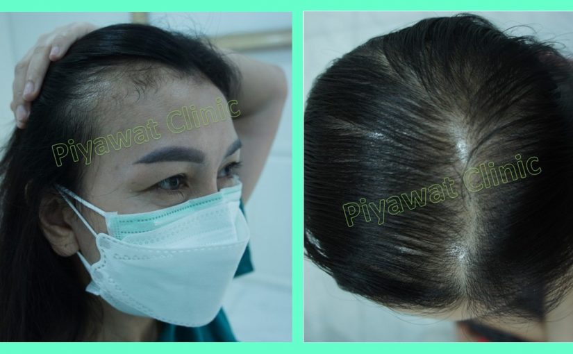 Common Hair Thinning in Women ปัญหาผมบางที่พบได้บ่อยในผู้หญิง