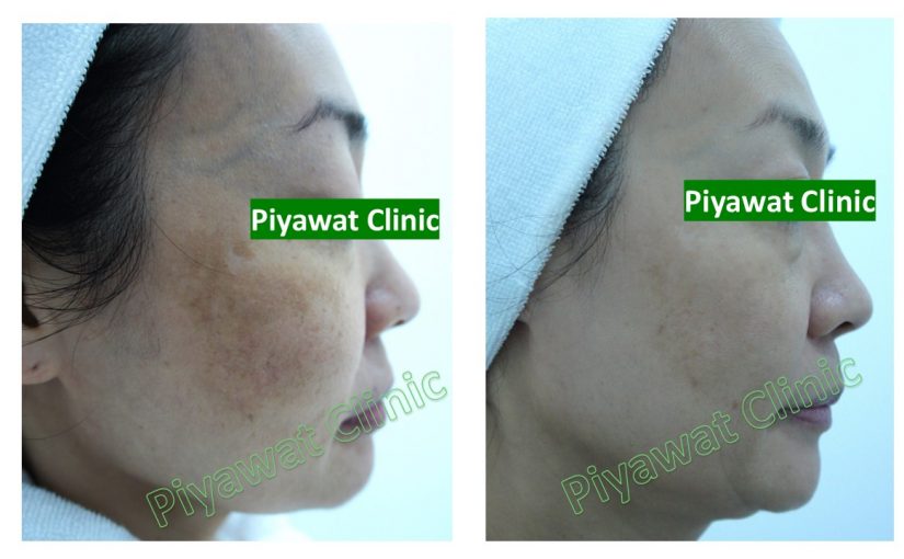 Low Fluence Q-switched Nd:YAG laser for Melasma Treatment