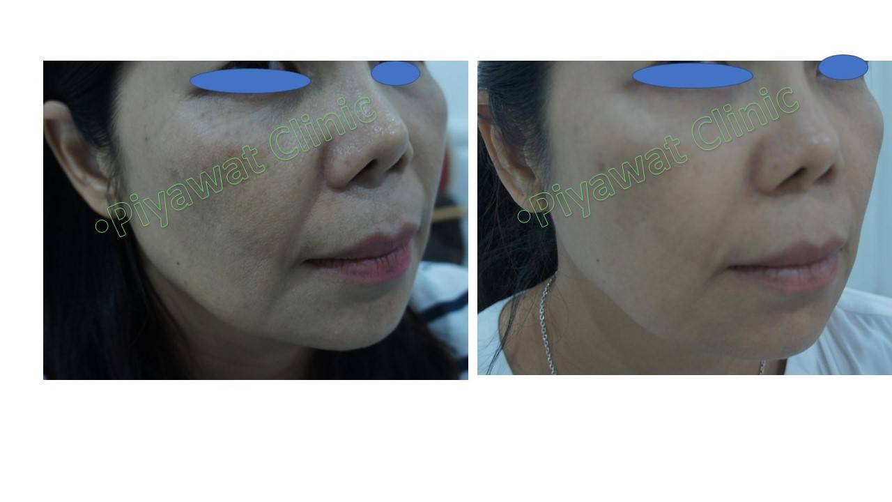 ๊อัลเทอรา