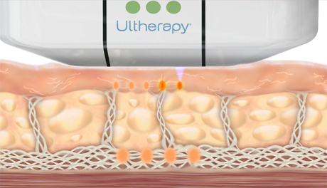 Why Face Lift:  Ulthera, HIFU, Thermage  Doesn’t Work?