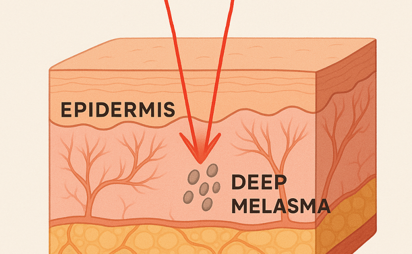 Why Q-switched Nd:YAG Laser Is Ideal for Treating Deep Melasma?